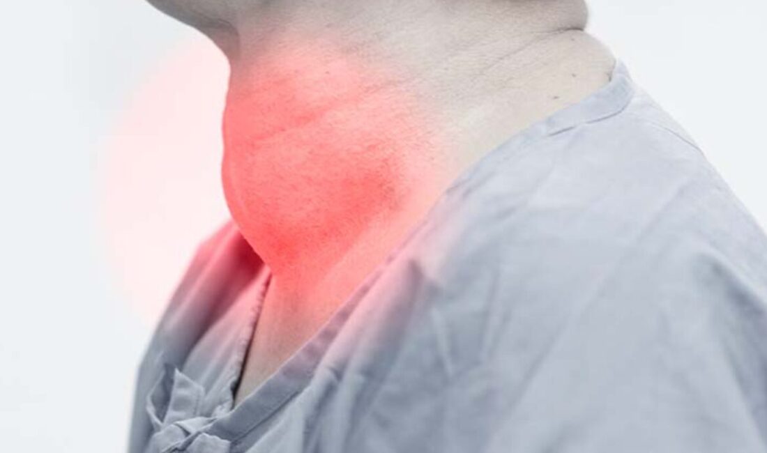 Boynunuzda şişlik varsa dikkat ! Toplumda yaygın olarak görülen endokrin hastalıklardan biri olan guatr, tiroid